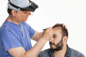 Hair Transplants in Chicago Can Restore Your Youthful Looks